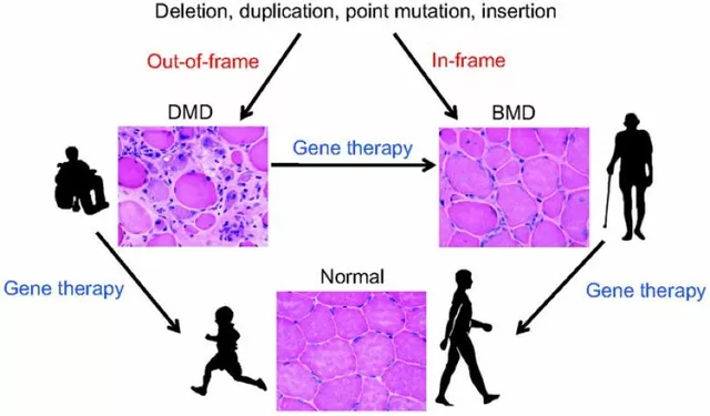 The Future of Duchenne Muscular Dystrophy: Gene Therapy and Beyond
